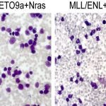 bone marrow leukemia