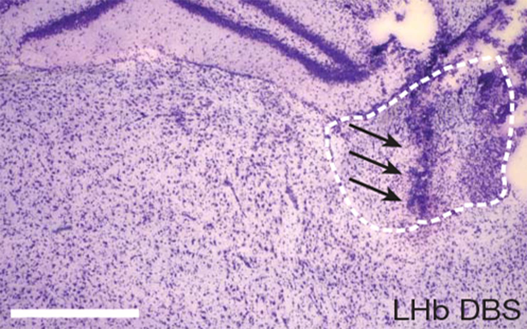 lateral habenula