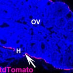 Ovarian cancer