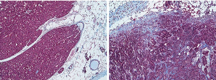 Breast Cancer tumor micro-environment
