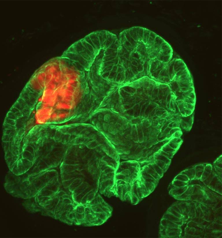 Prostate tumor