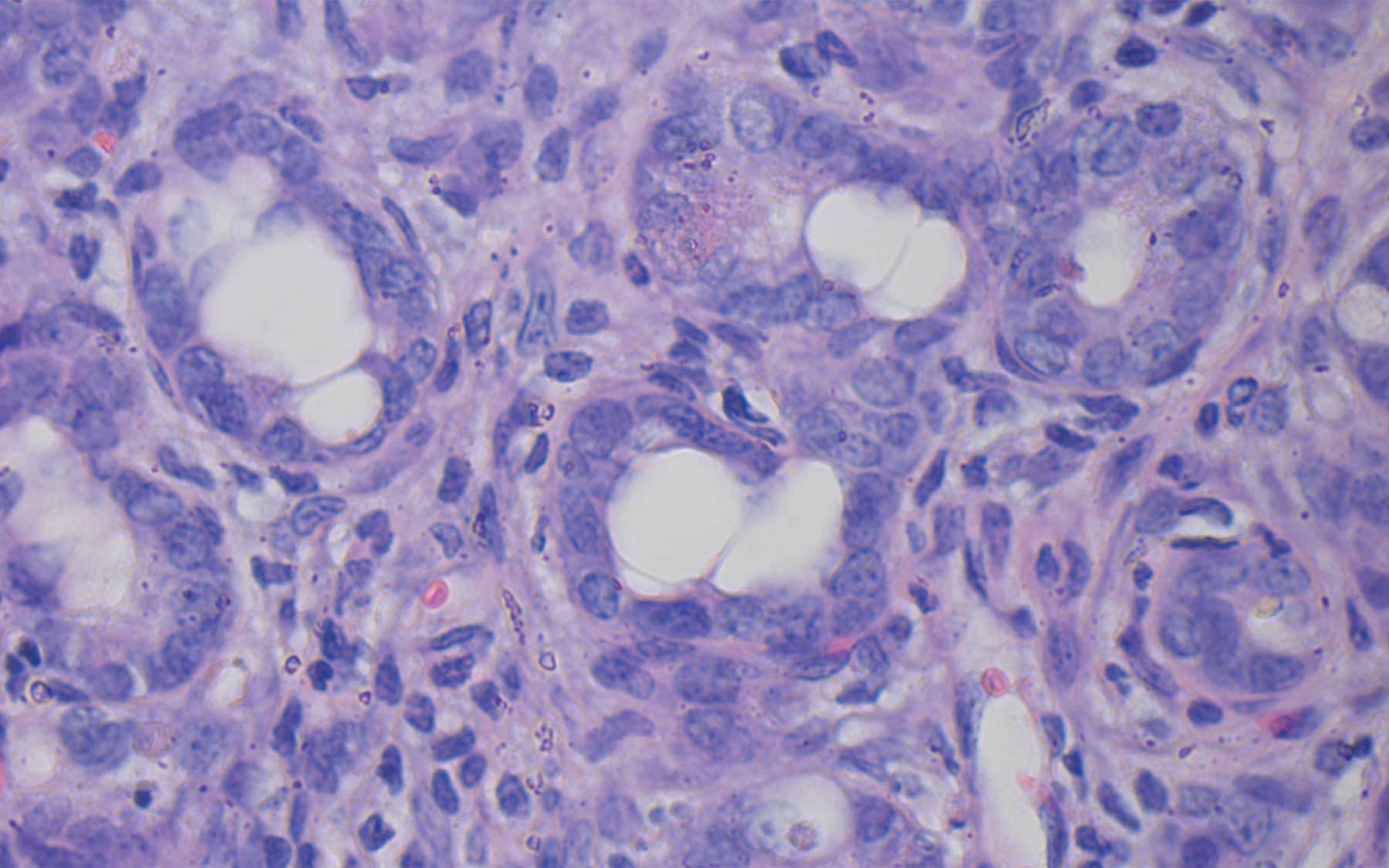 When Antioxidants Are Pro-cancer