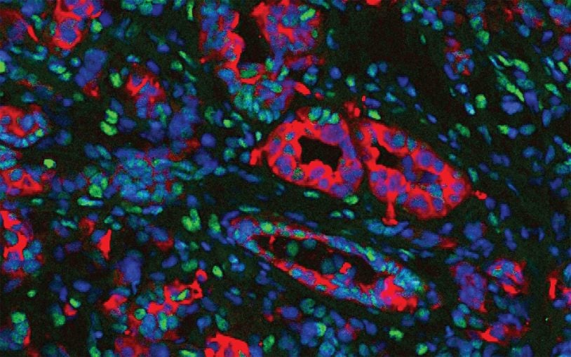 Discovery of distinct cell subtypes around tumors helps explain why pancreatic cancer is so hard to treat