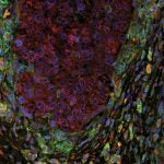 human lung cancer tumor