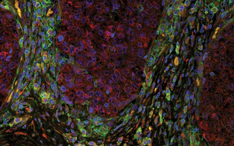 human lung cancer tumor