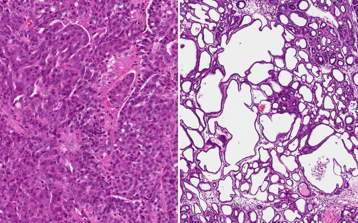 metastatic breast tumor