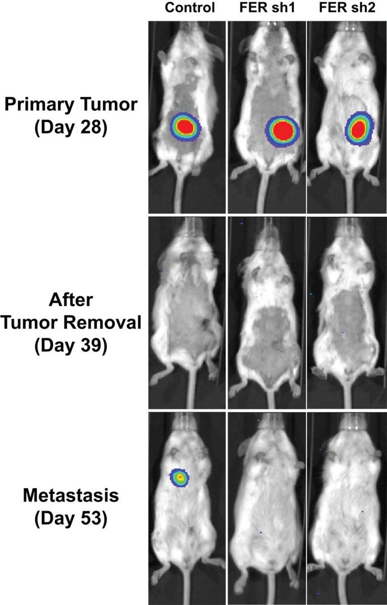 ovarian cancer metastasis