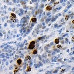 pancreatic cancer cells