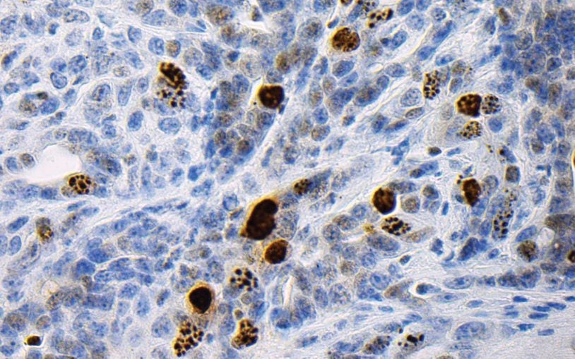 pancreatic cancer cells