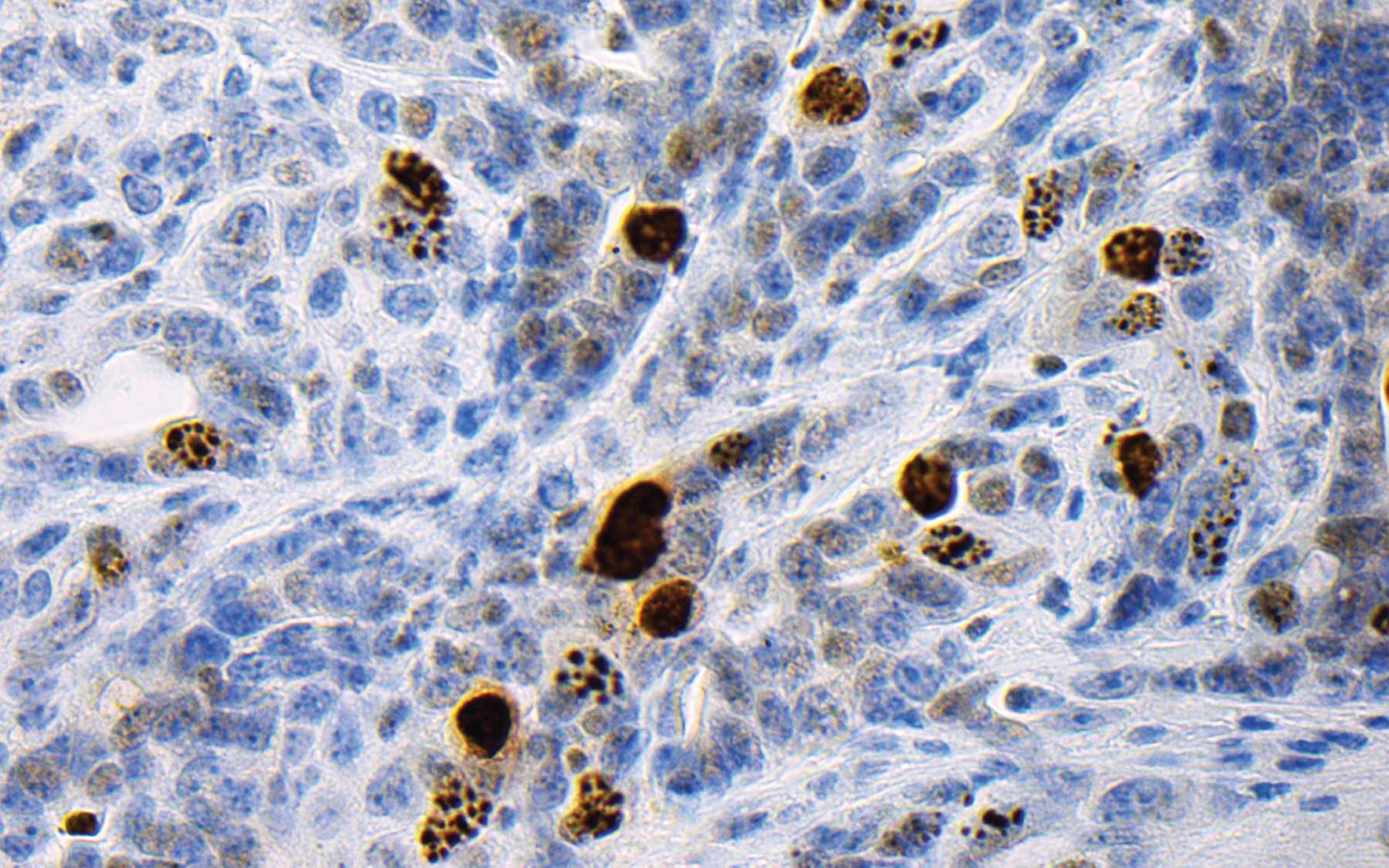 pancreatic cancer cells