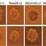 human colon cancer cells