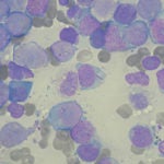 Acute myeloid leukemia cells