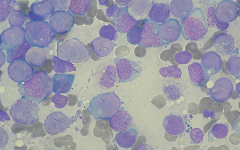 Acute myeloid leukemia cells