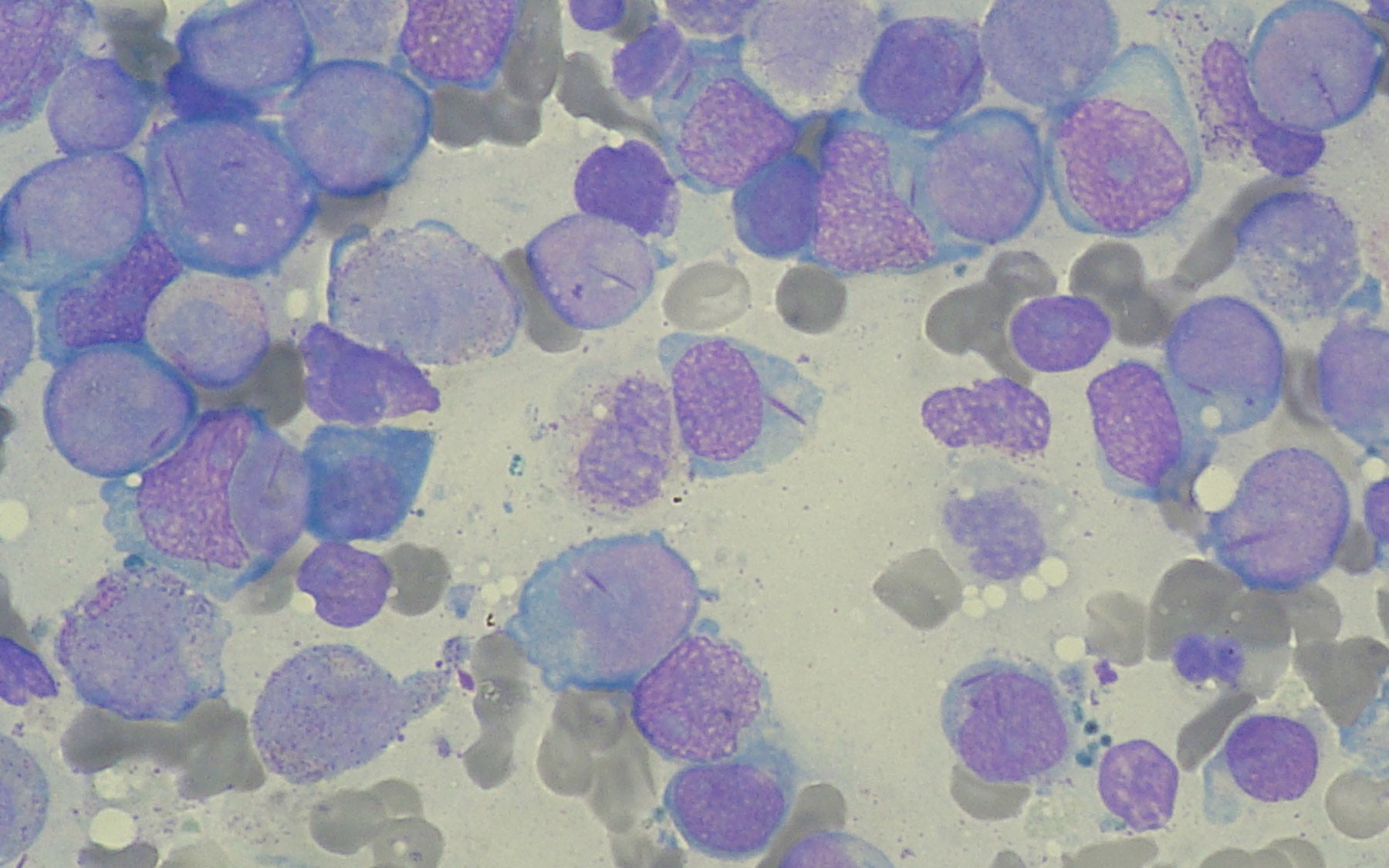 Acute myeloid leukemia cells