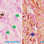 Breast Cancer metastasizing