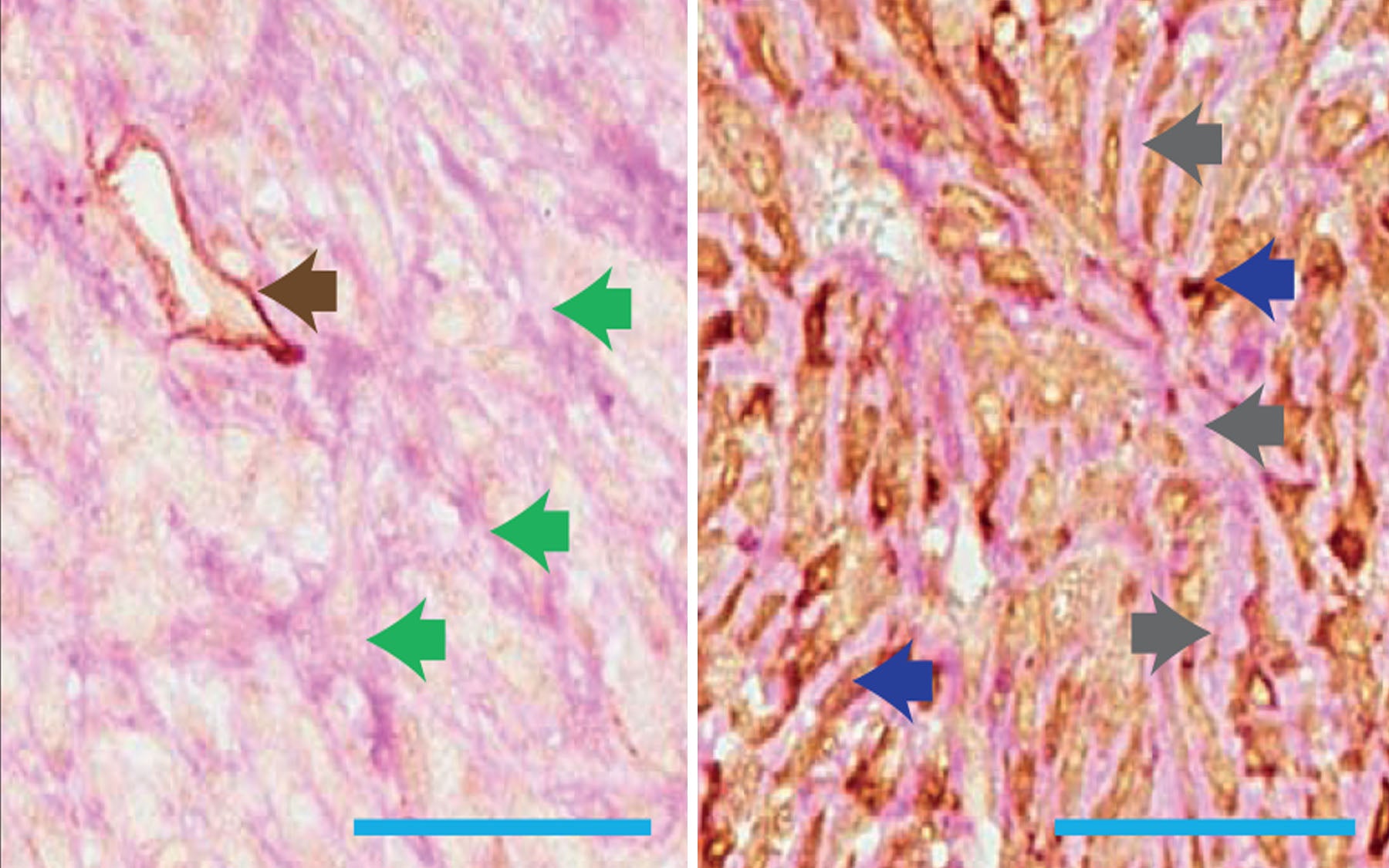 Breast Cancer metastasizing