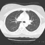 Sordella_CT cross sectional image of lungs
