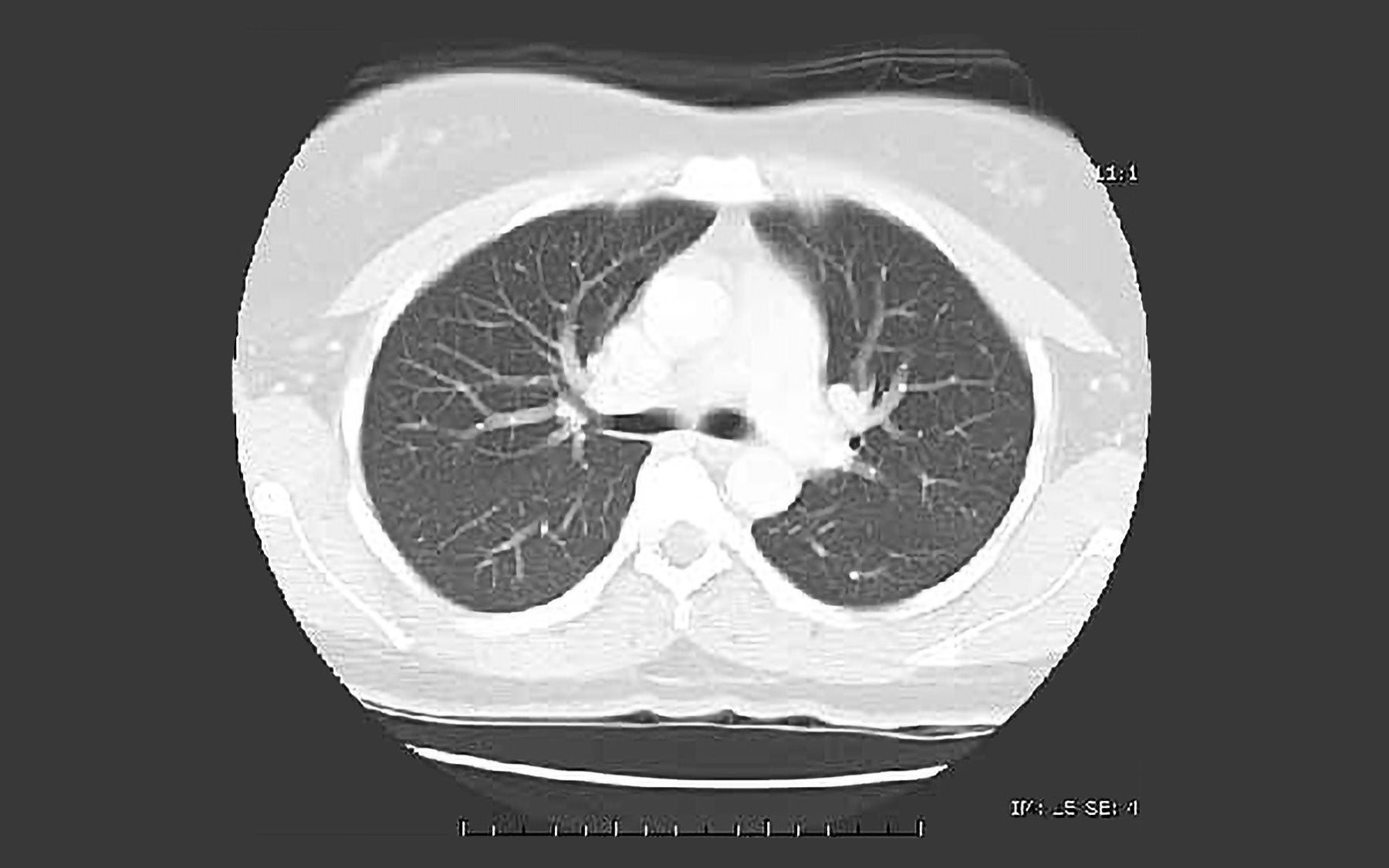 Sordella_CT cross sectional image of lungs