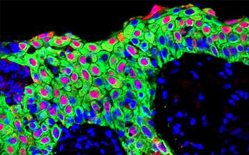 Overexpression of splicing protein involved in skin repair causes early changes seen in skin cancer