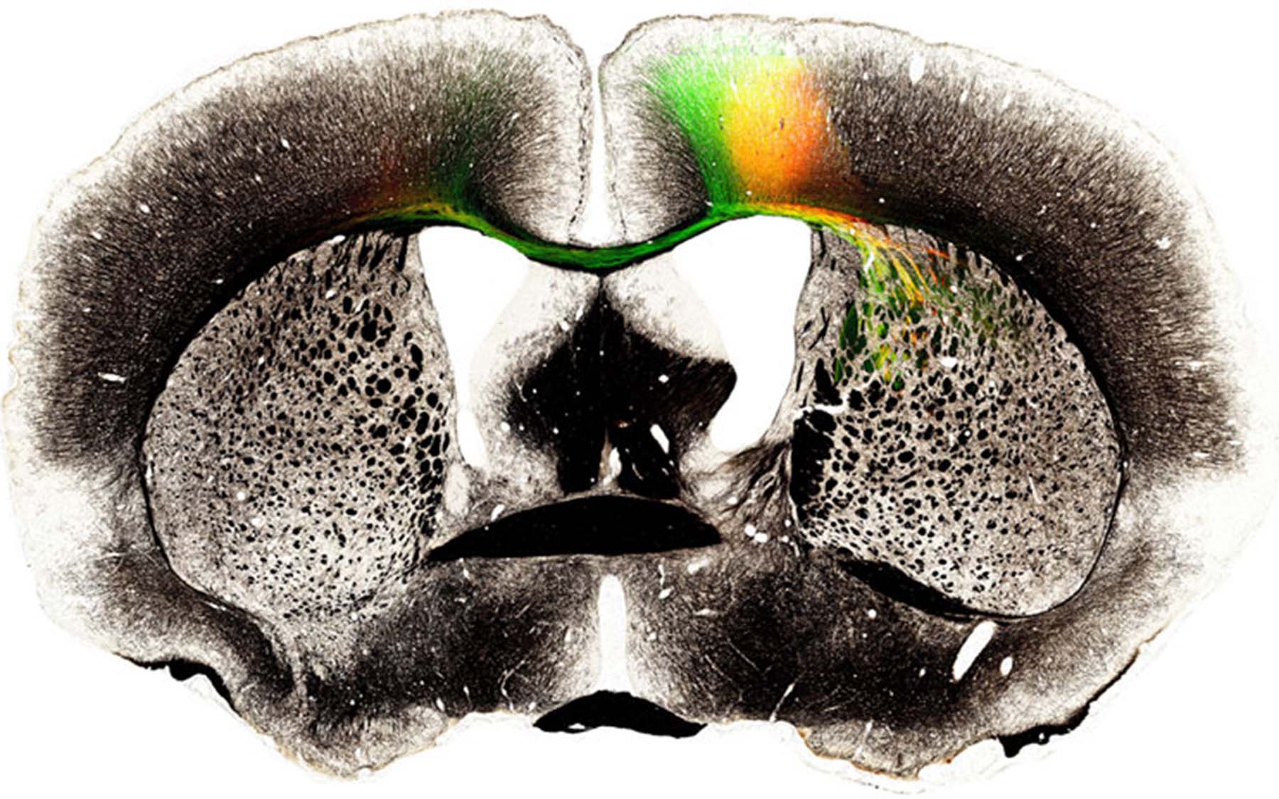 Myelin AAV Combination