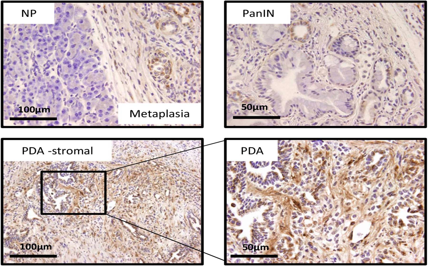 CTGF in KPC tumors