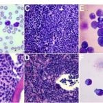 Histopathology Acute Myeloid Leukemia