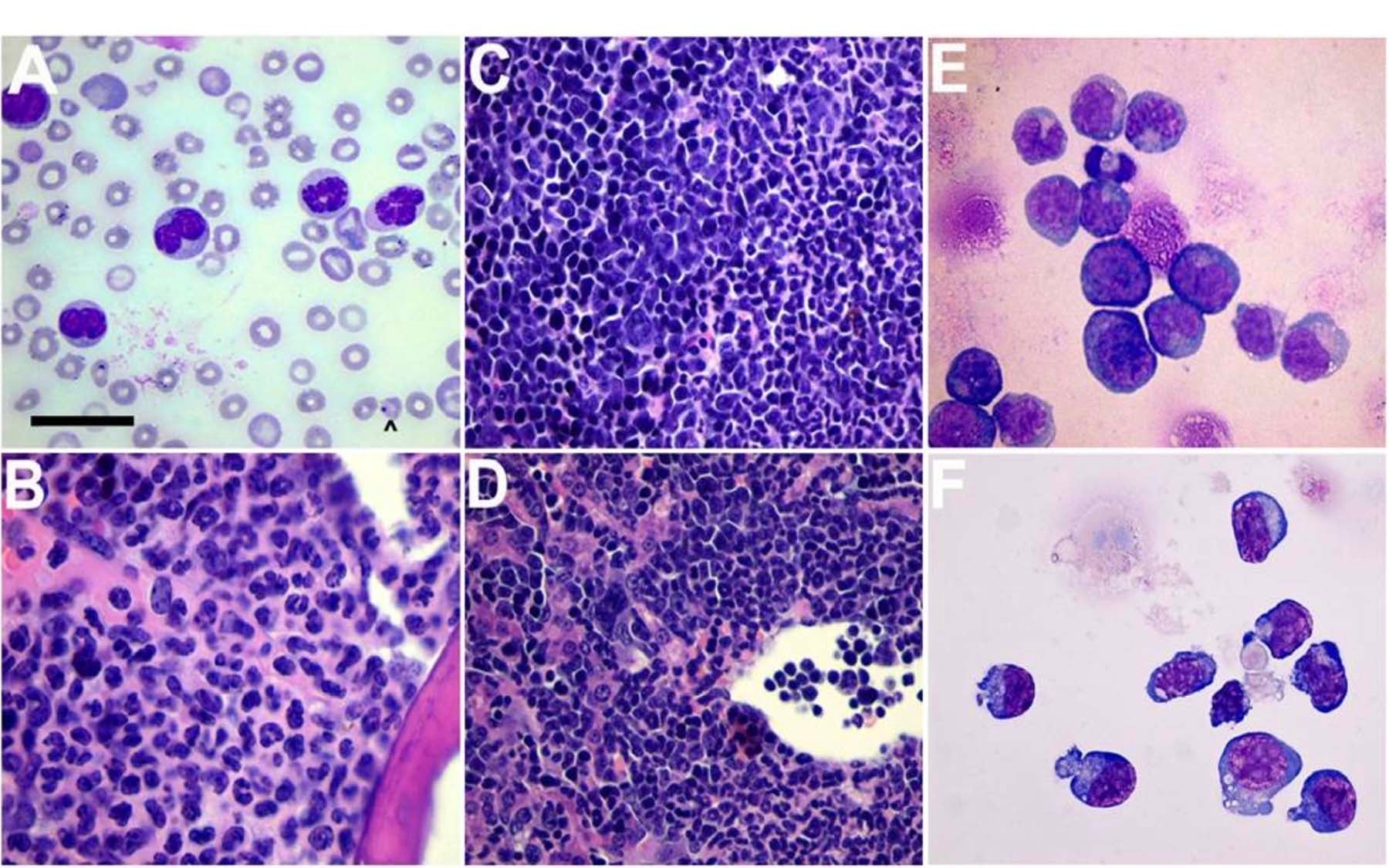 Histopathology Acute Myeloid Leukemia