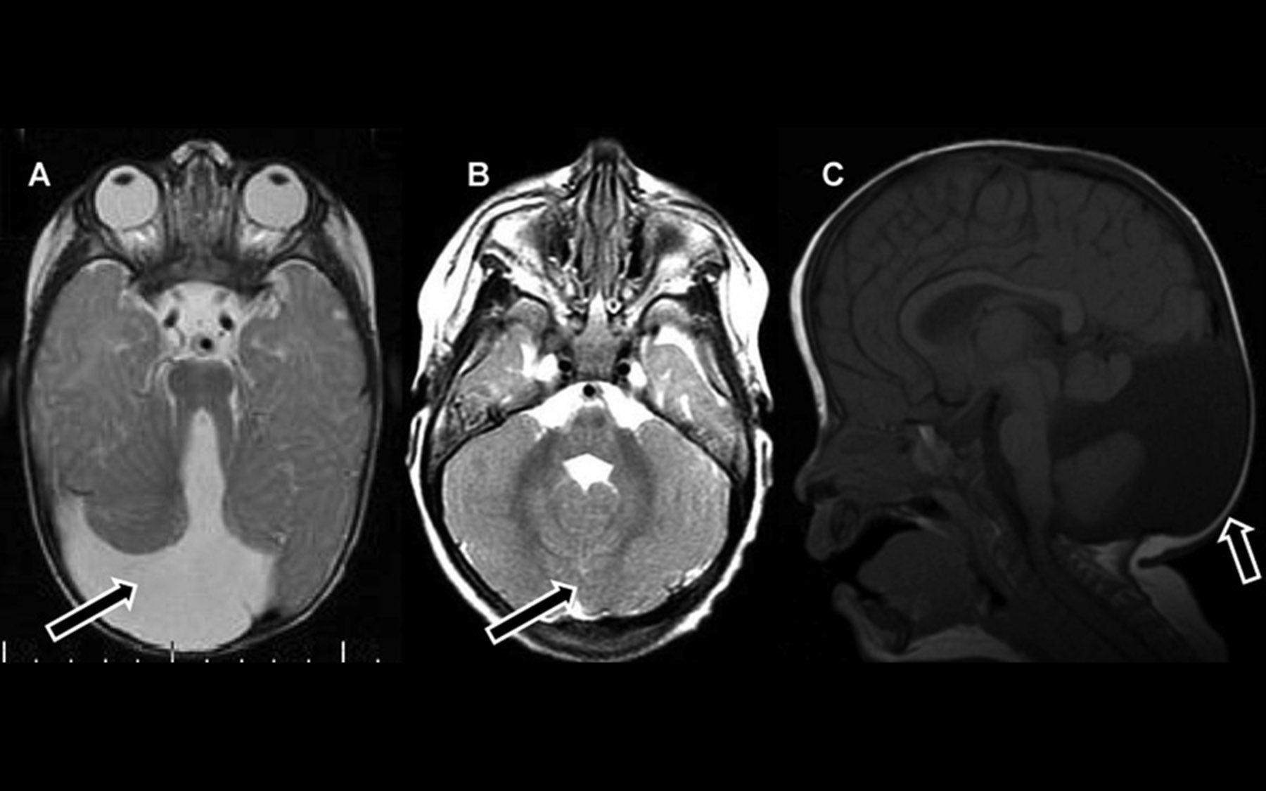 Joubert Syndrome 2 (JBTS2) in Ashkenazi Jews