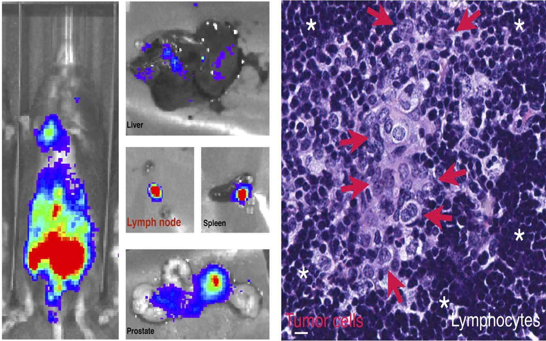 Trotman Phlpp2 cancer metastasis