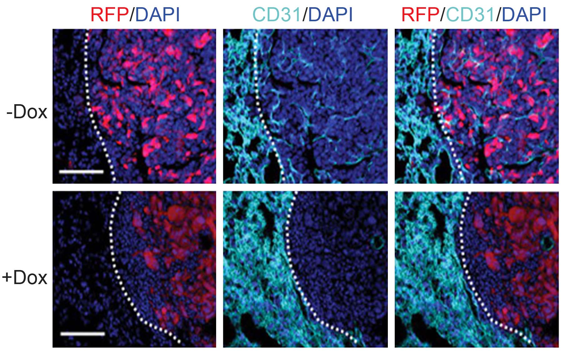 CD31 staining pulmonary metastases