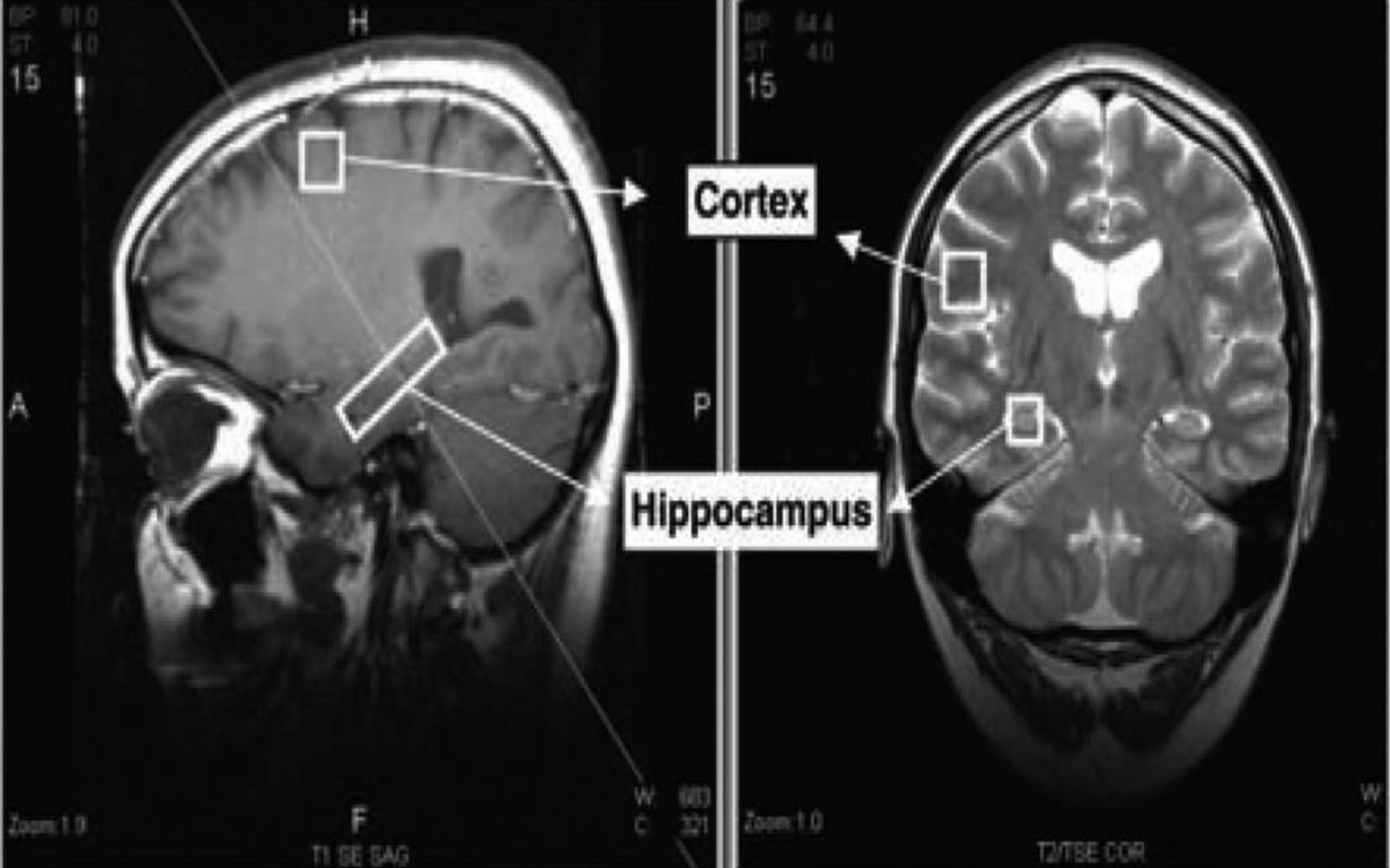 NPCs in human hippocampus