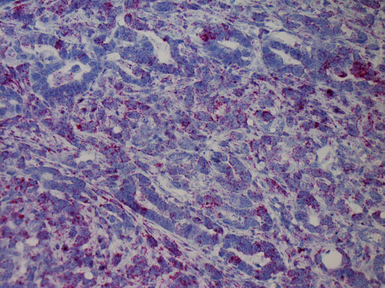 image of SOAT1 pancreatic tumor in mouse