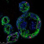 image of human pancreas tumor organoids
