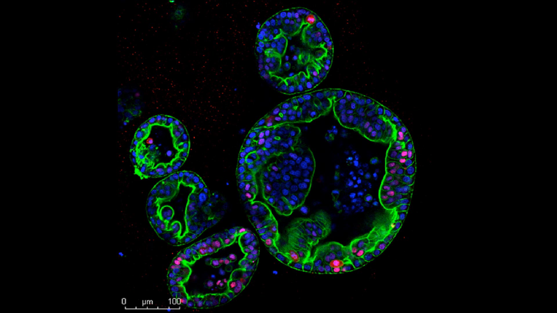 image of human pancreas tumor organoids
