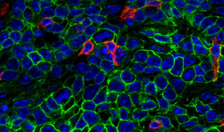 image of killer t-cells in breast cancer tumor
