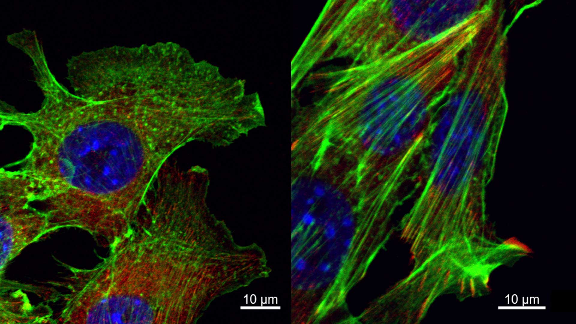 image of cancer cell movement and metastases