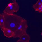 Image of epithelial cell lung tumors