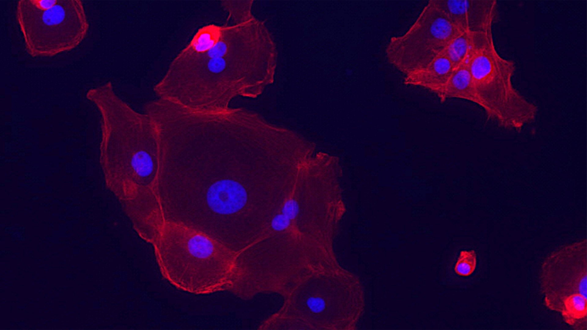Image of epithelial cell lung tumors