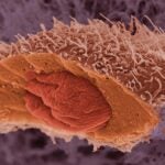 image of a skin cancer cell
