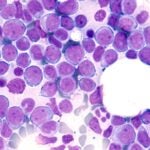 image of a bone marrow sample with leukemia