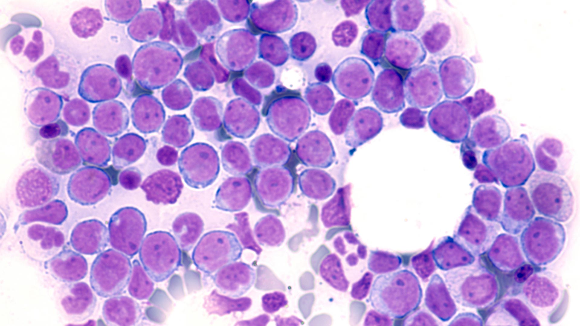 image of a bone marrow sample with leukemia