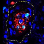 image of overactive immune cells in human lung