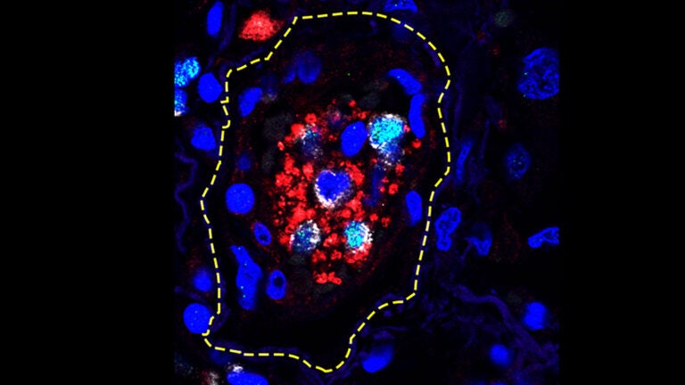 image of overactive immune cells in human lung