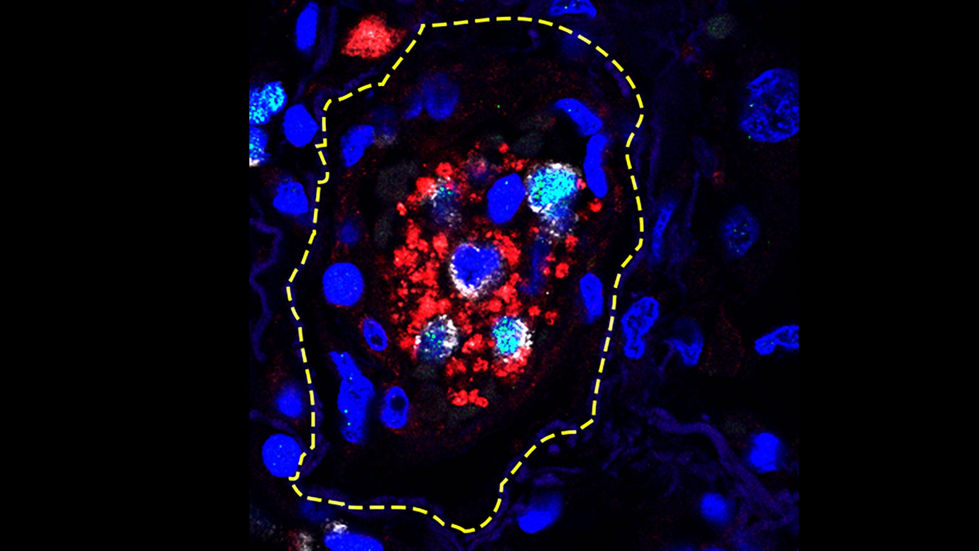 image of overactive immune cells in human lung