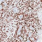 image of squamous cells carcinoma