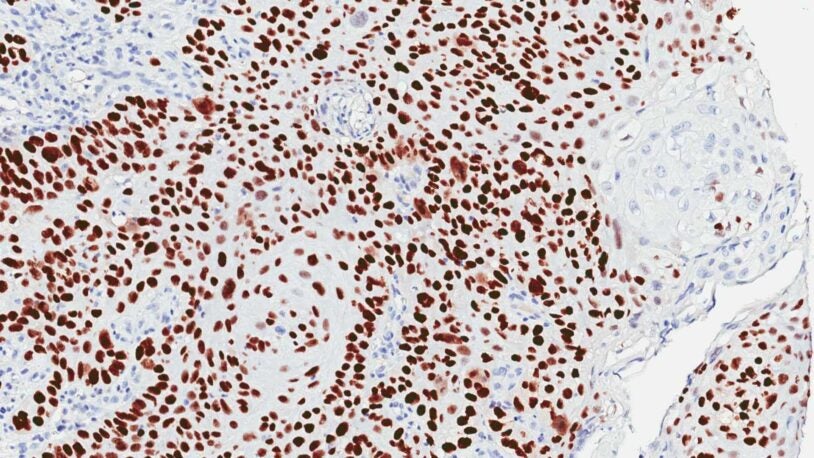 image of squamous cells carcinoma