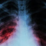 chest x-ray of human lungs with pulmonary tuberculosis