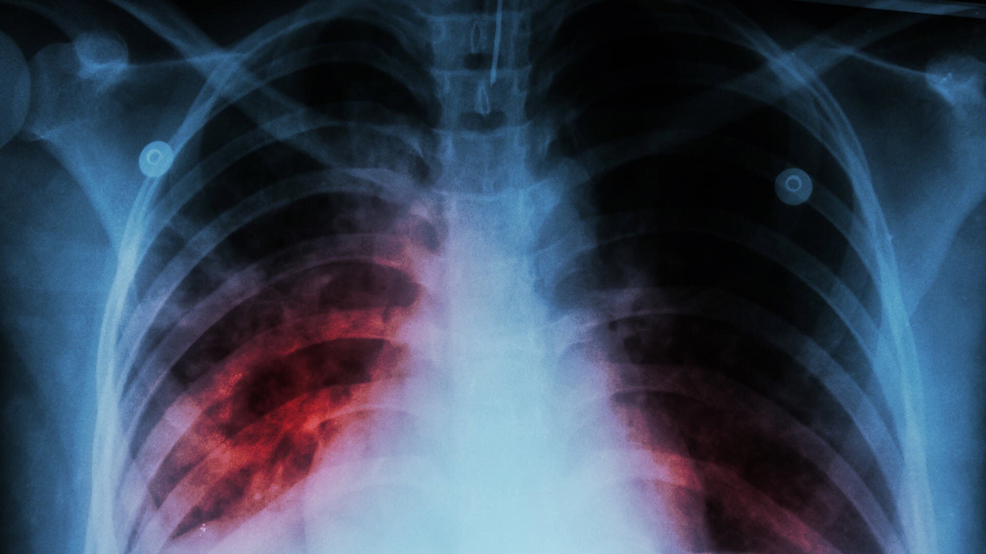 chest x-ray of human lungs with pulmonary tuberculosis