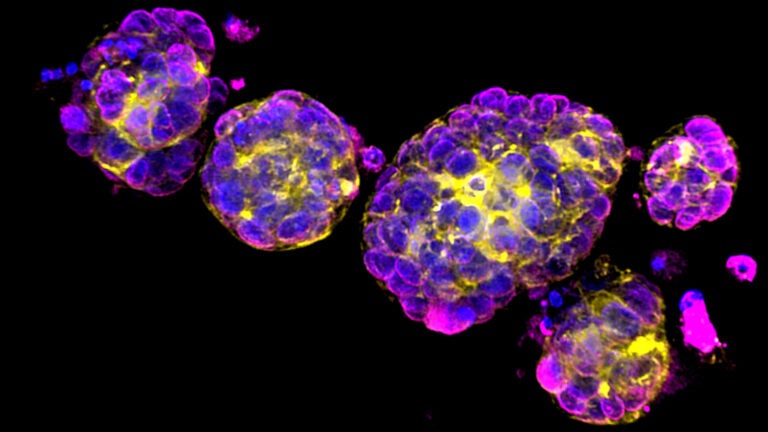 image of breast cancer organoids