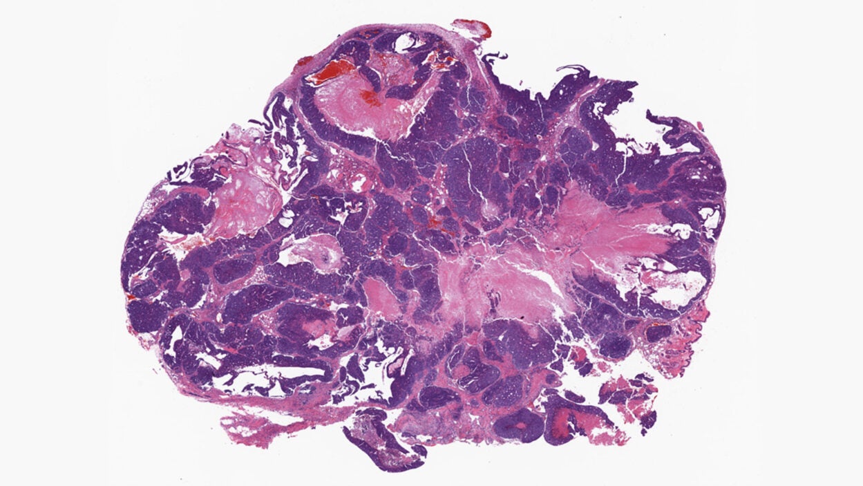 photo of breast cancer tumor cross section